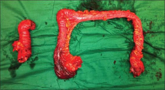 Adult Rectosigmoid Junction Intussusception Presenting With Rectal