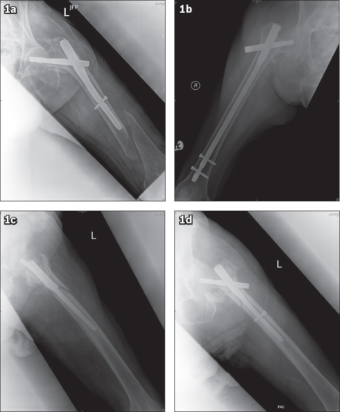 The long and short of cephalomedullary nails in the treatment of  osteoporotic pertrochanteric fracture | SMJ