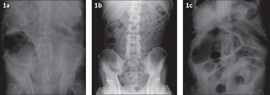 rectosigmoid cancer stent