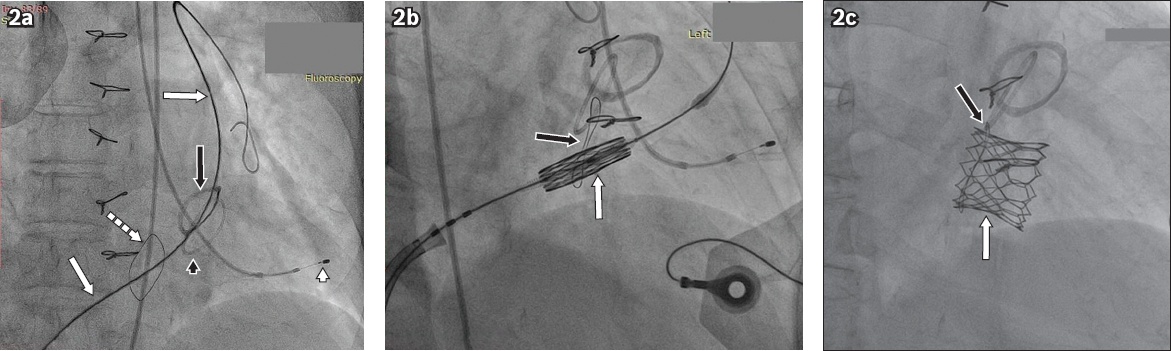 Transfemoral Transcatheter Tricuspid Valve Replacement Of A Degenerated