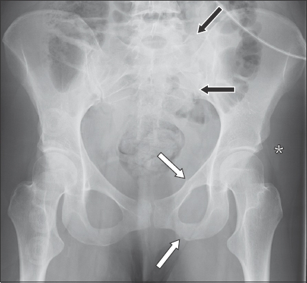 sacrum anatomy xray