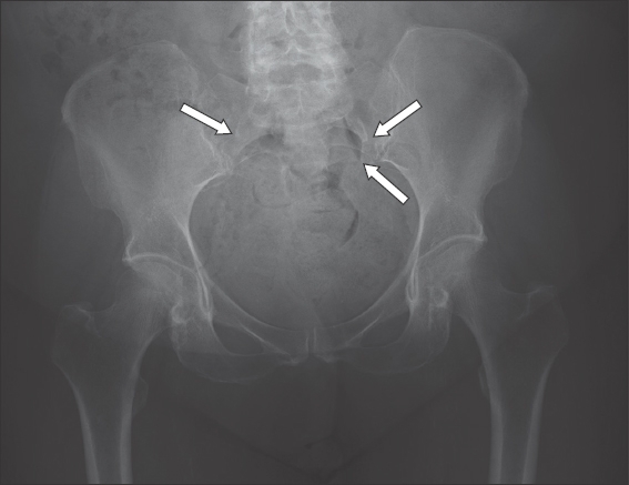 sacrum anatomy xray